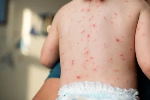 Catapora em bebê: sintomas, tratamento e quando procurar o médico